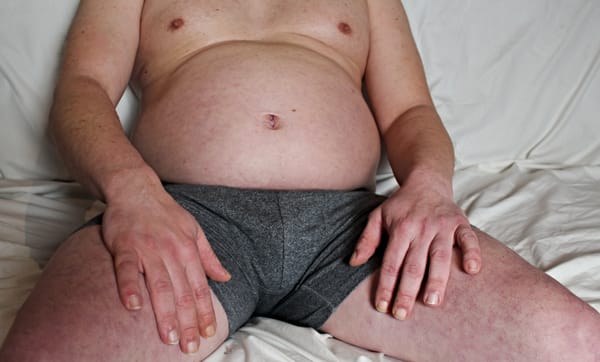 The Dick Diaries: MS